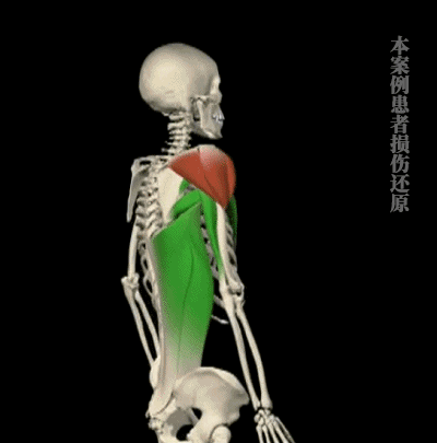 臀上皮神经损伤示意图年轻人摸高够物时,上肢有足够的力量将躯体伸展