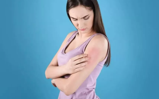 湿疹 你中招了吗?