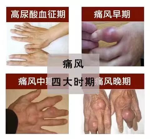 痛风难逃的三大并发症寿命减少1020年