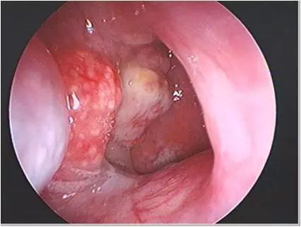 医生手记鼻腔里长的肉肉会癌变吗
