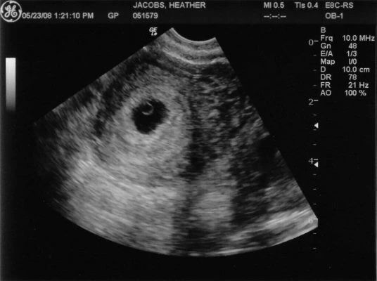 怀孕35天胚胎图图片