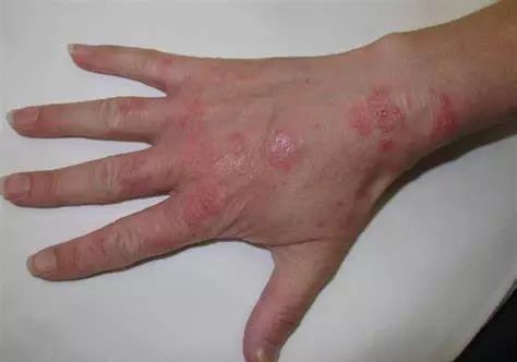 以及甲床足癣:脚的真菌感染许多不同种类的真菌可引起皮肤癣菌病