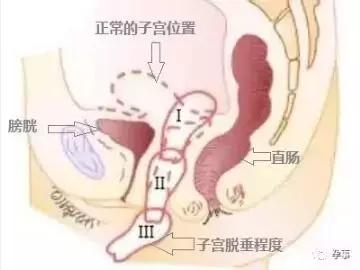 吓惨了2个月三胎孕妇子宫掉出来竟是忽略了这件事