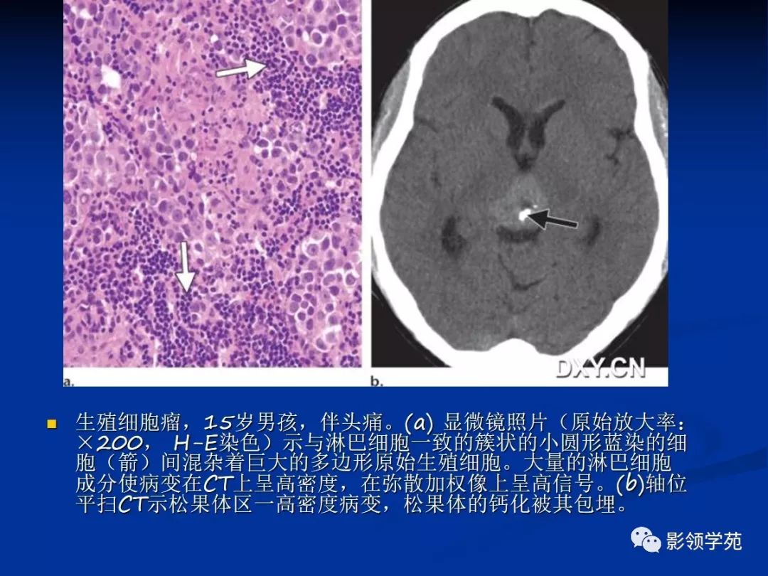 松果体区病变的影像病理对照