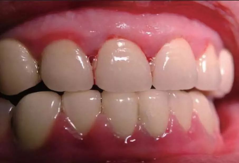 最近的研究有 · 社会底层青少年牙龈健康状况不佳