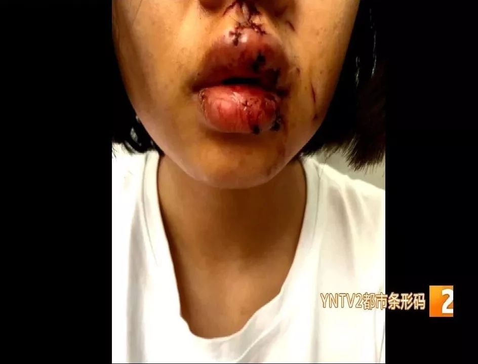 一口咬上来年轻姑娘被狗咬脸毁容狗主无法接受赔偿68万元