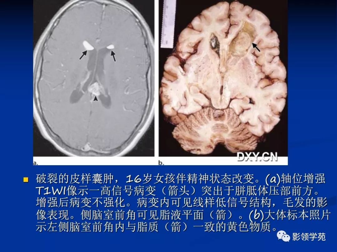 松果体钙化ct图片图片