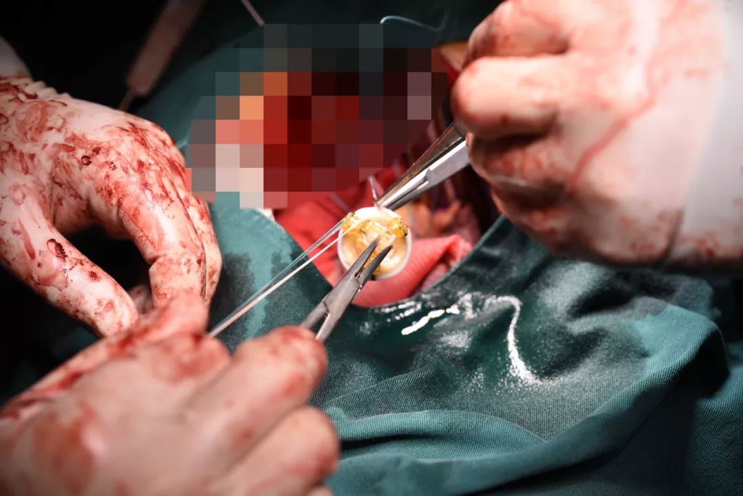 明慈心外科6小时手术摘除10厘米大人体炸弹