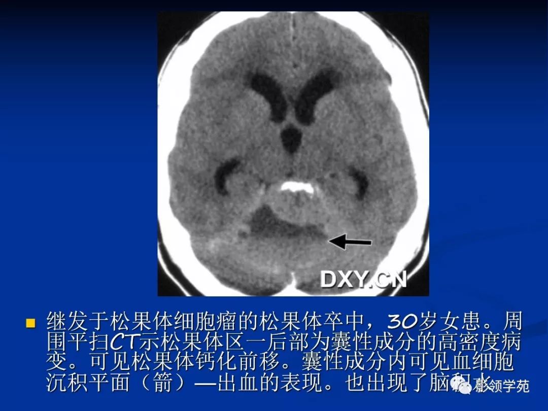 松果体区病变的影像病理对照