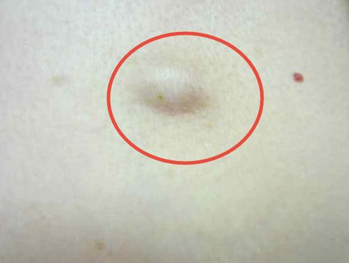 乳房皮肤卫星结节图片图片