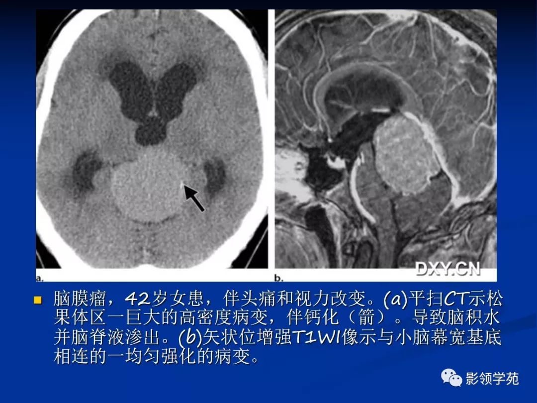 松果体区病变的影像