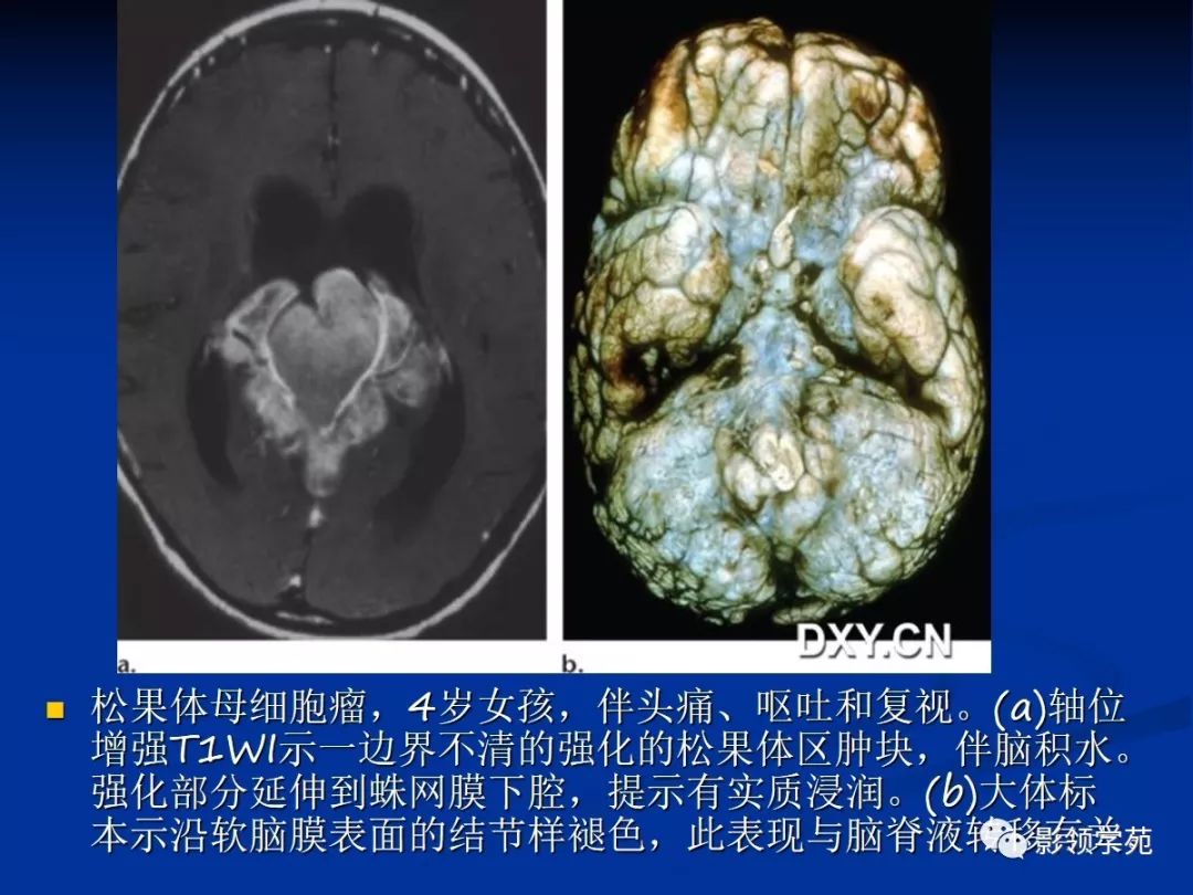 松果体区病变的影像病理对照