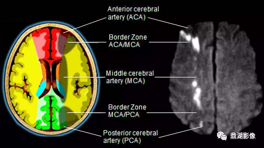 clinical features and the degree of cerebrovascular stenosis in