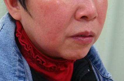 3,卡马西平,拉莫三嗪可能会引发严重的皮肤反应.