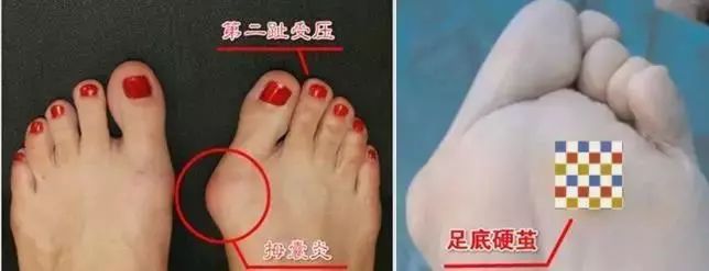 关爱女性拇外翻是中老年女性的高发病只因年轻时不注意这件事