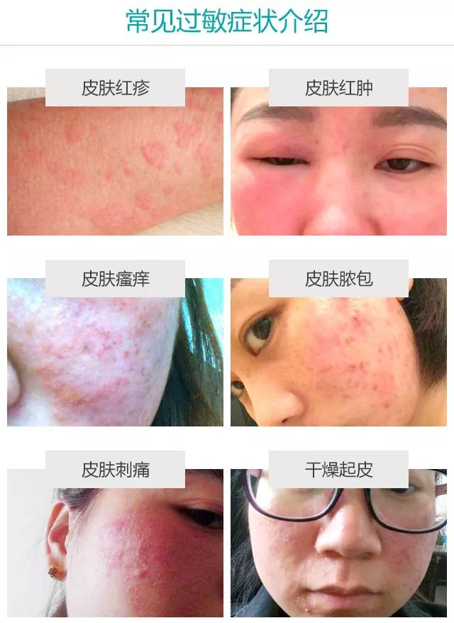 秋季过敏高发出疹子红肿瘙痒怎么办