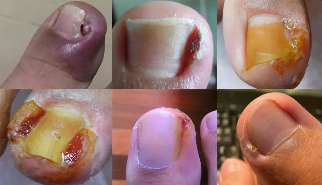 脚趾甲长到肉里巨痛用它轻松剪掉甲沟嵌甲甲沟炎没了走路更舒服