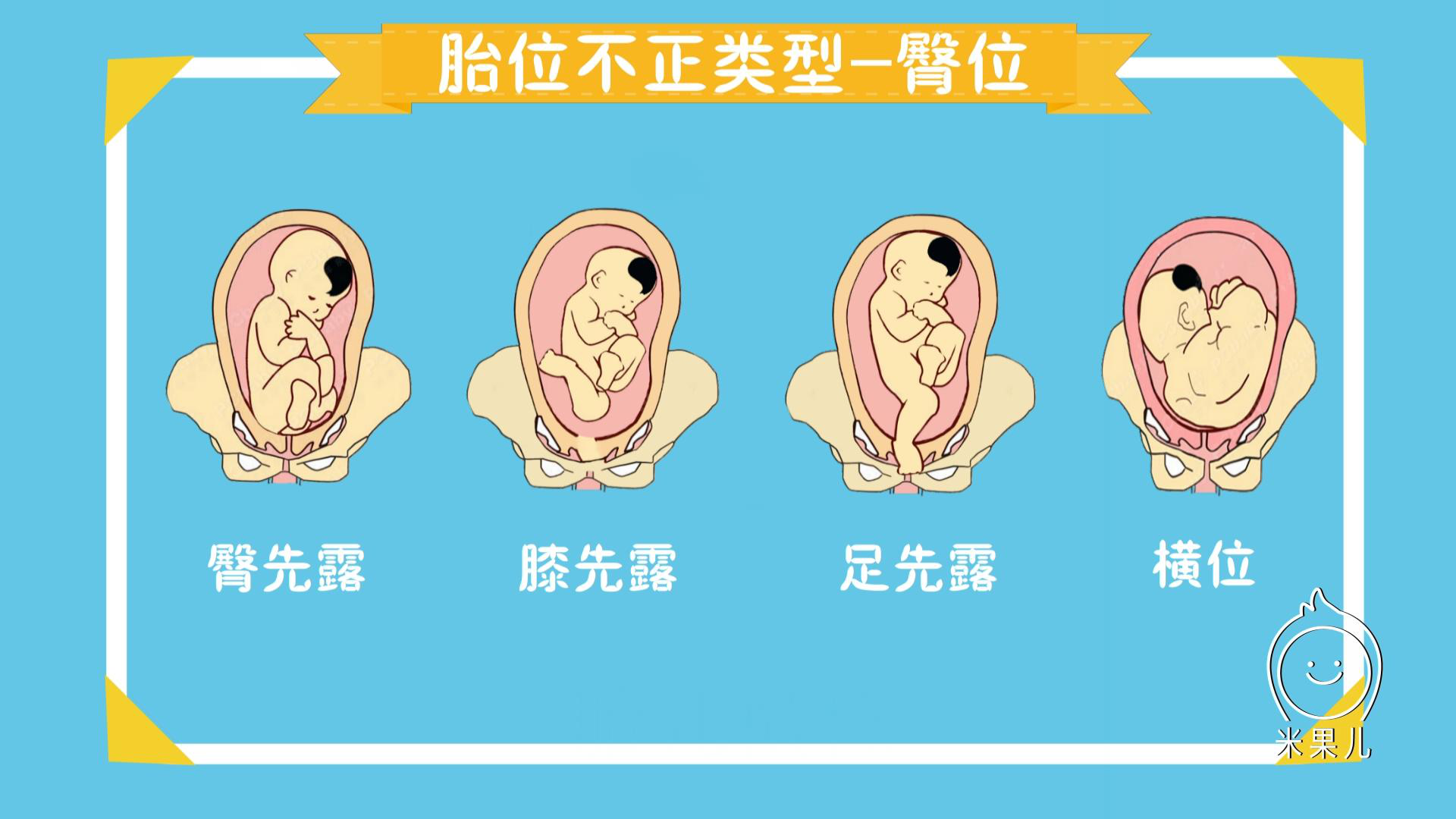 右枕后位胎儿图图片