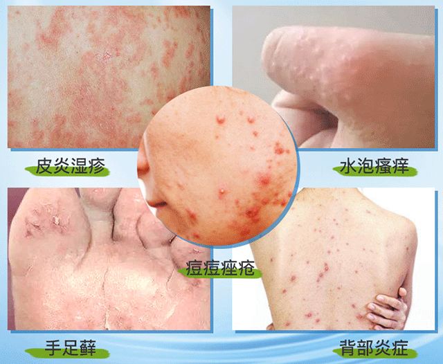 痒痒痒痒痒痒用路边这种草煮水一洗10痒9消连皮炎湿疹都好了