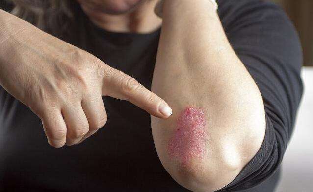 成人湿疹如何护理?