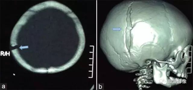少见的颅骨生长性骨折内附影像及手术图片