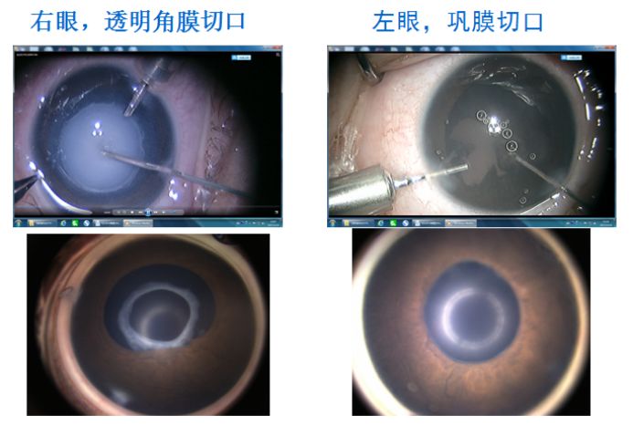 ccos白內障丨鮑永珍教授嬰兒期白內障微創聯合手術