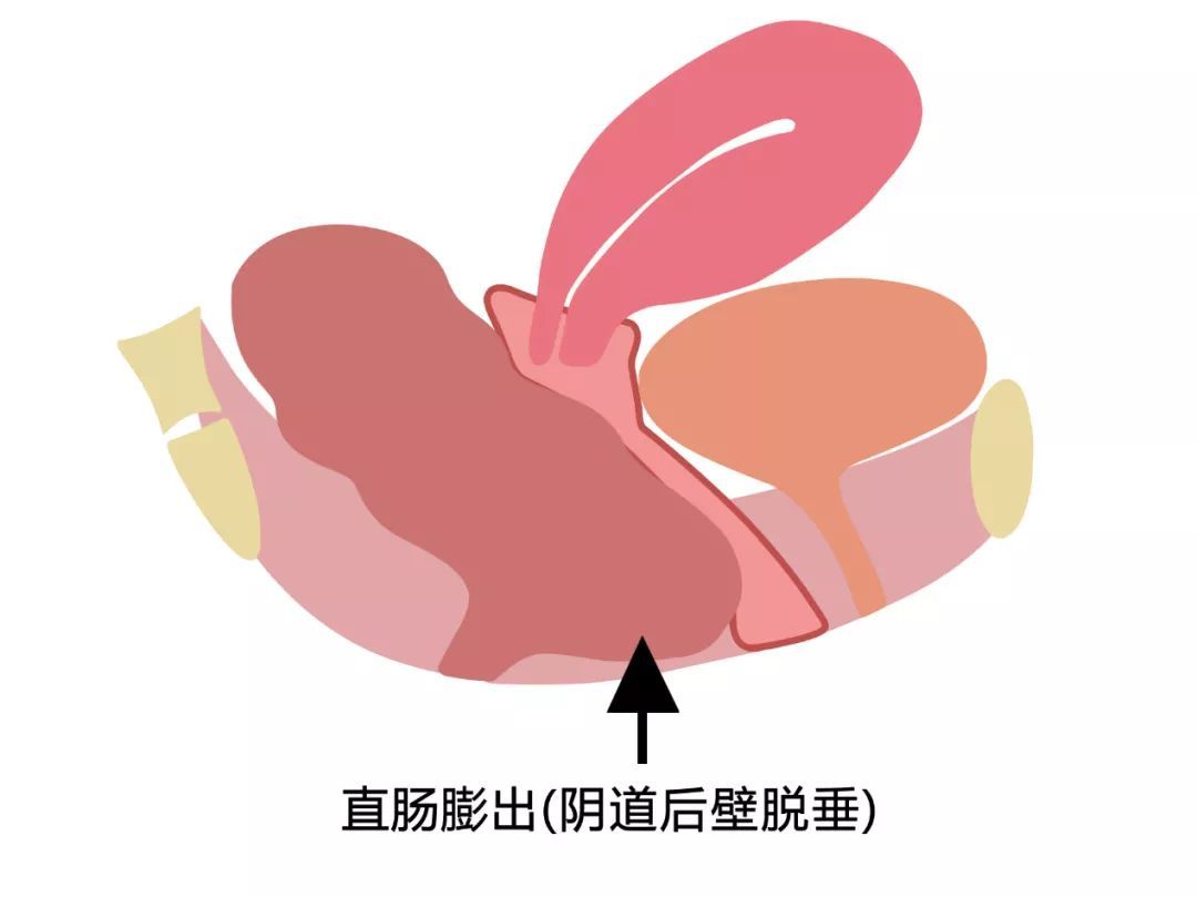阴道后壁膨出(实际为直肠膨出)(实际为膀胱或尿道膨出)阴道前壁膨出