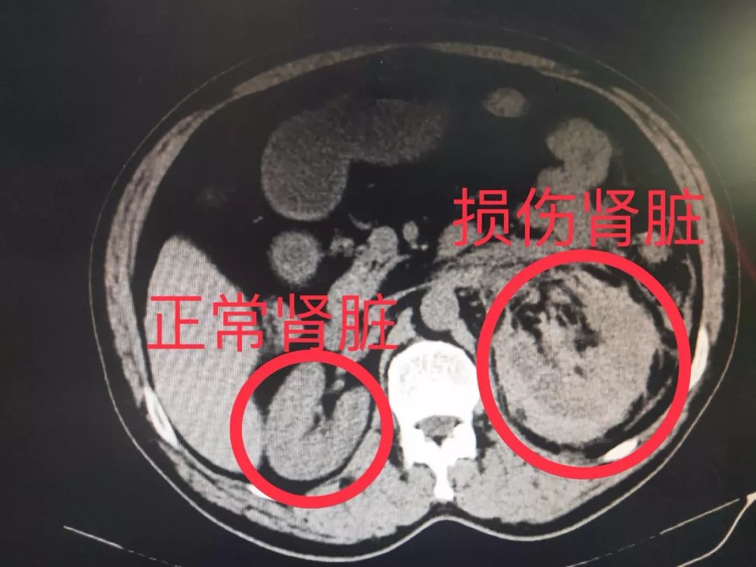 我联系了神经外科,泌尿外科,很快把两人收入院,当天晚上,颅脑损伤的