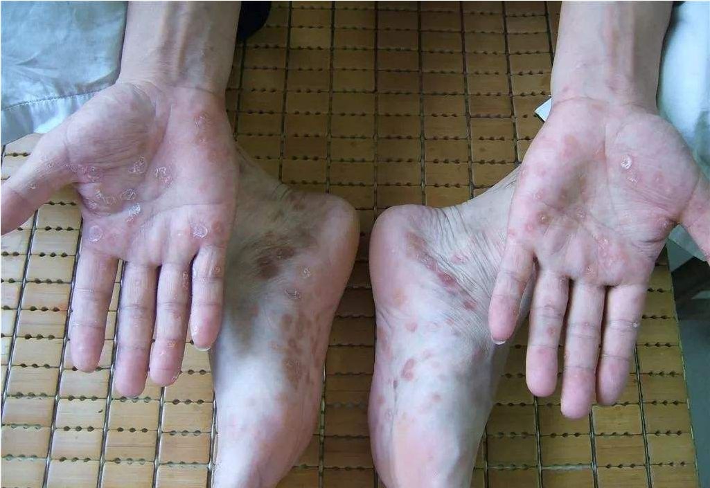 【同济·科普】痒痒痒,手足癣复发怎么办?_真菌