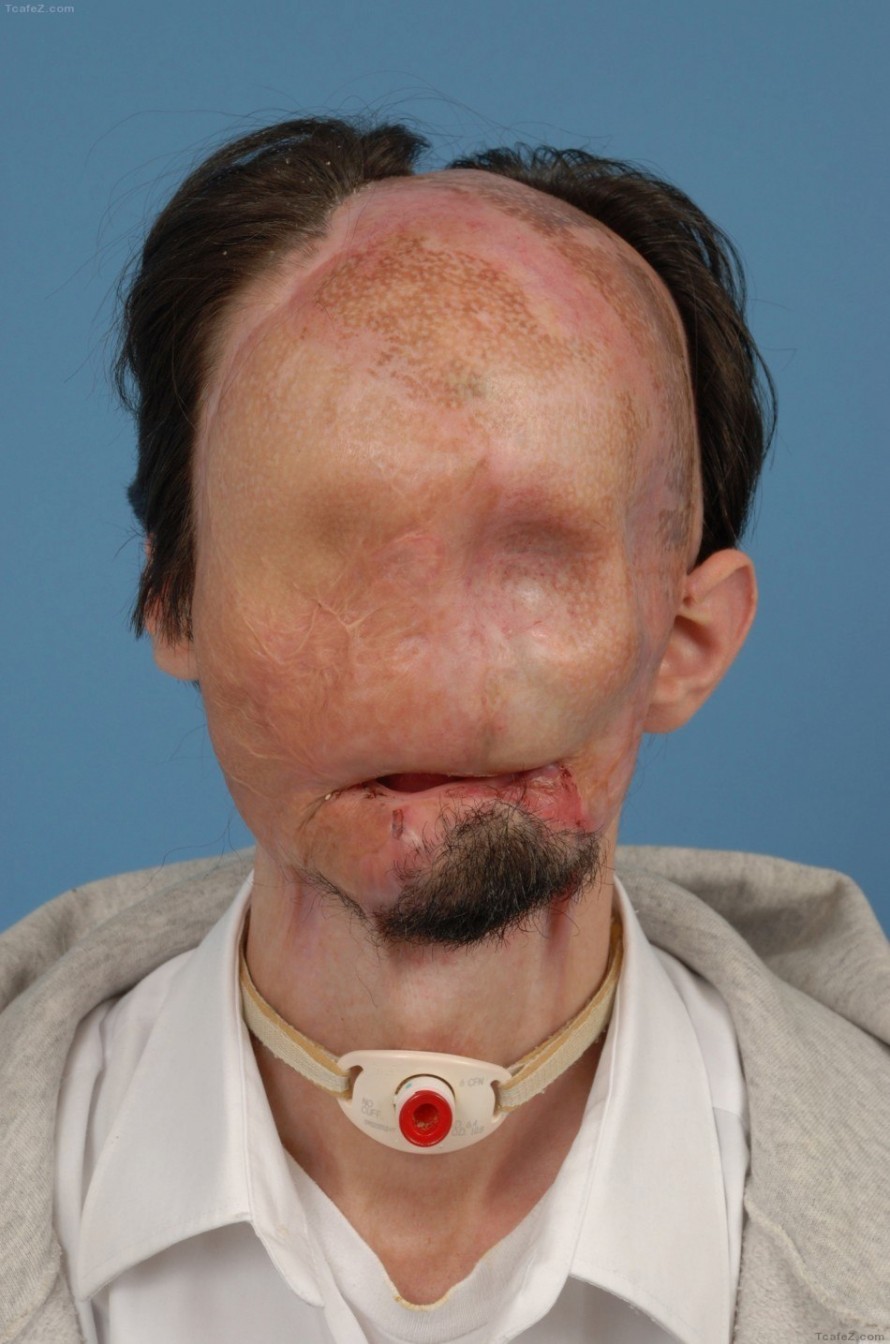 男子因车祸失去整张脸通过换脸手术再次获得妻子和女儿的爱