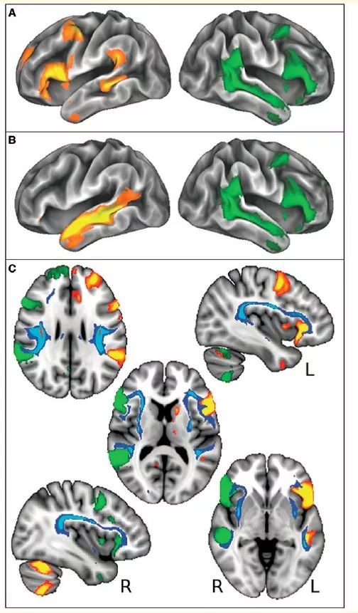 brain科學家確定與左撇子有關的大腦遺傳區域