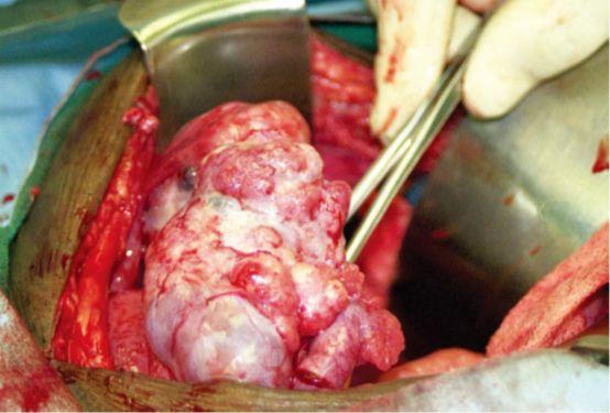卵巢癌的外科治疗