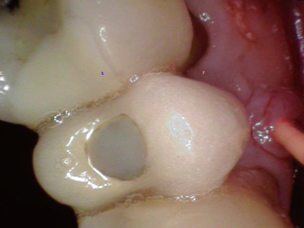 牙龈瘘管症状图片图片