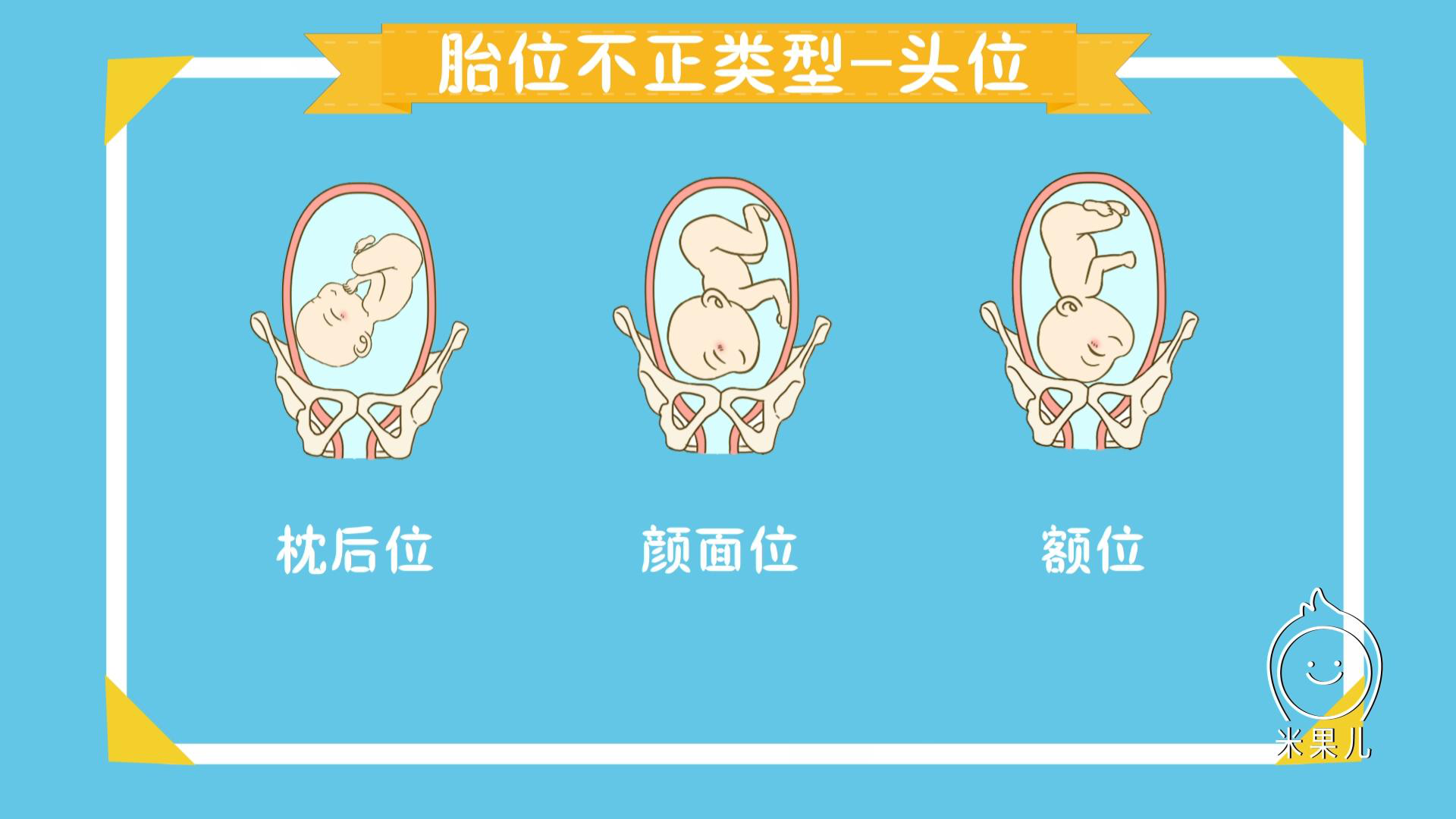 胎位右枕后位置示意图图片