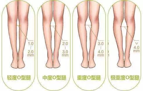 如何让o型腿变直你需要看看这篇o型腿理疗瑜伽体式方案