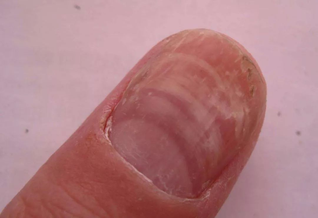 指甲松脆易受损甲病困扰爱美人士的天敌