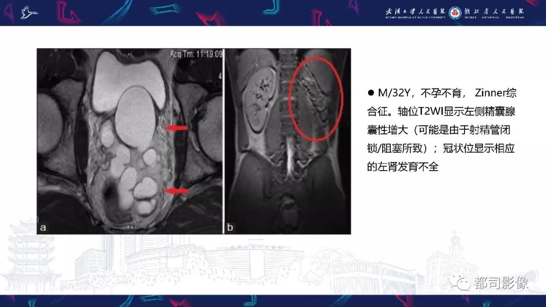 精囊腺病变mri表现