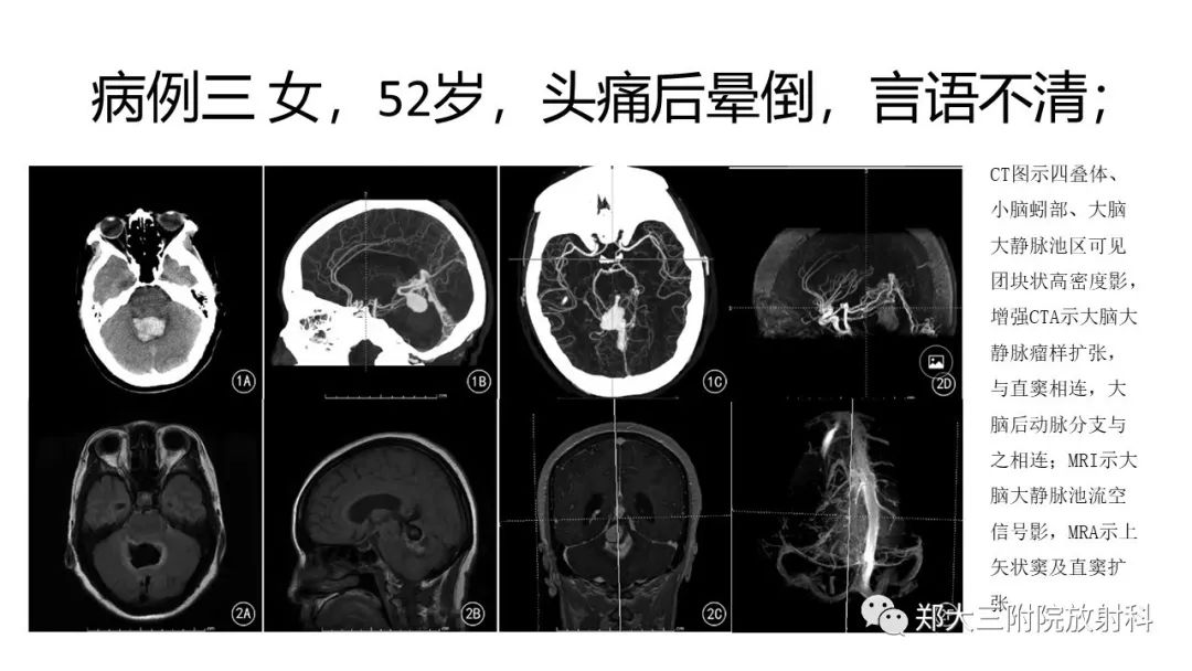 galen静脉动脉瘤样畸形的影像表现