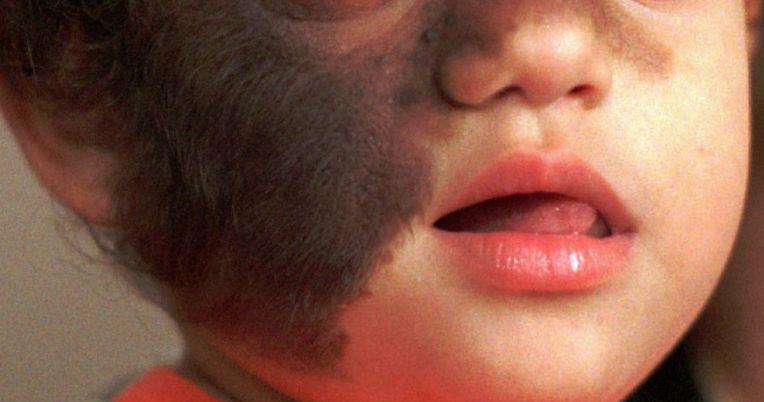 婴儿服用受污染的药物后患上了罕见的狼人综合症_毛发