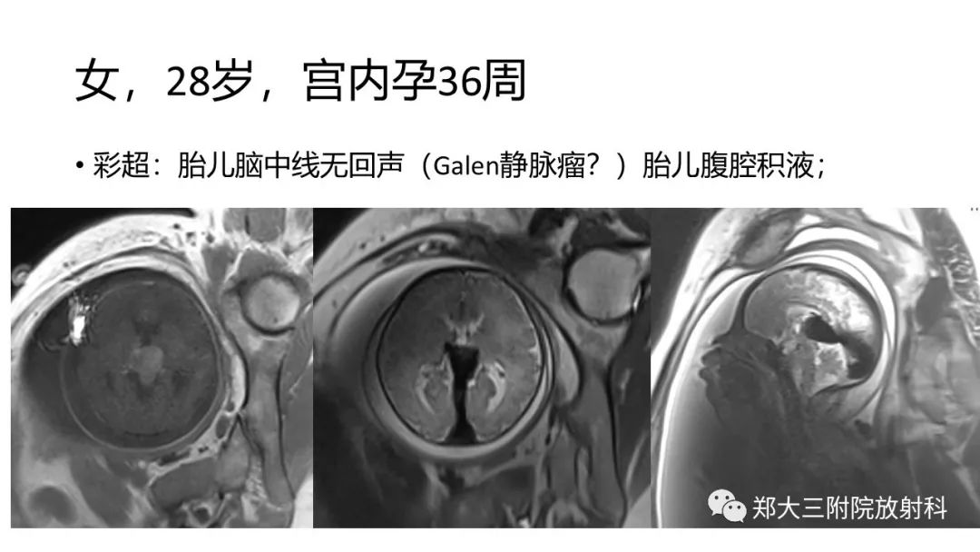 galen靜脈動脈瘤樣畸形的影像表現