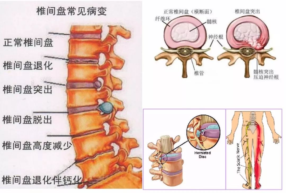 辩腰腿痛之脊柱病的真面目