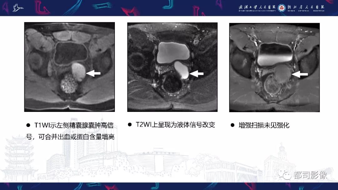 精囊腺病变mri表现