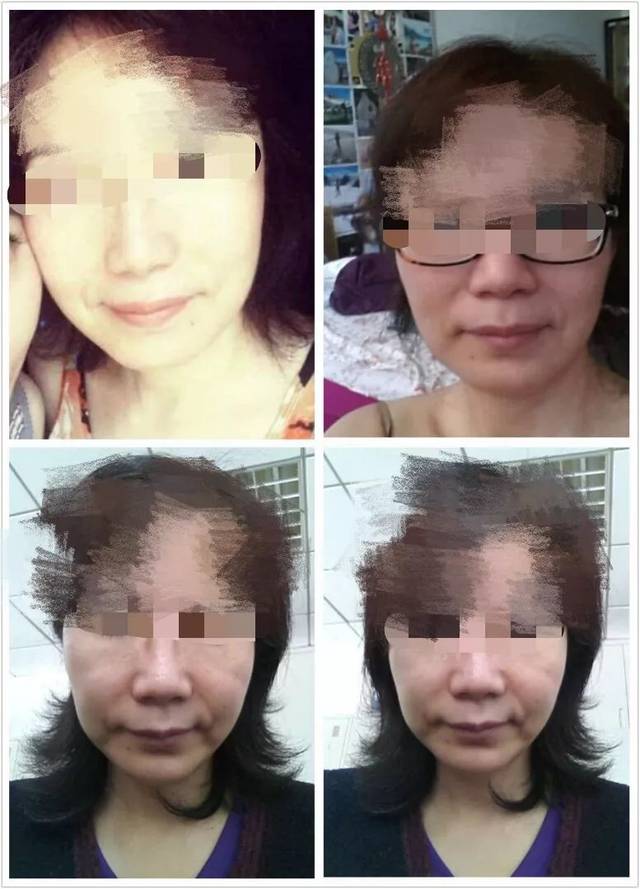 女子被瘦脸针毁容之后一针下去整张脸就垮了