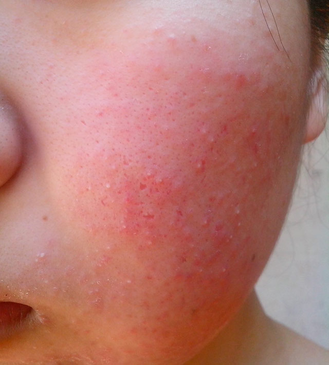 以为是皮肤问题,其实是螨虫过敏的一些症状