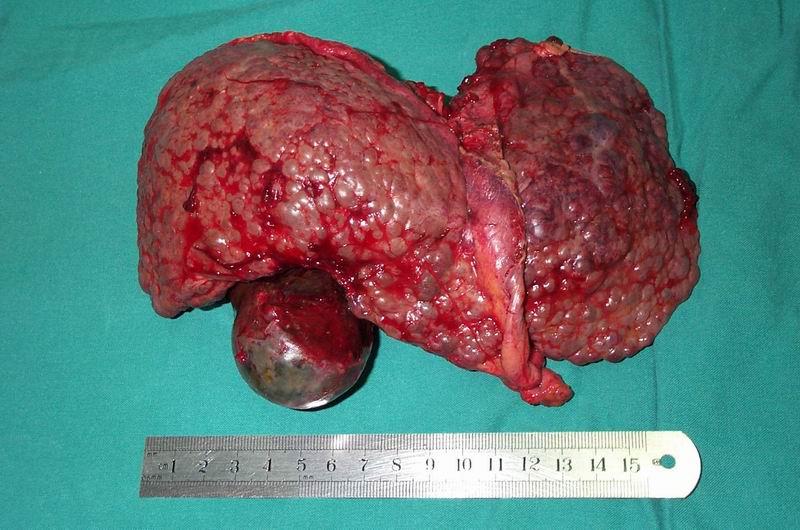 身体出现这4种反应,小心肝硬化找上你,早养肝预防癌症_肝脏