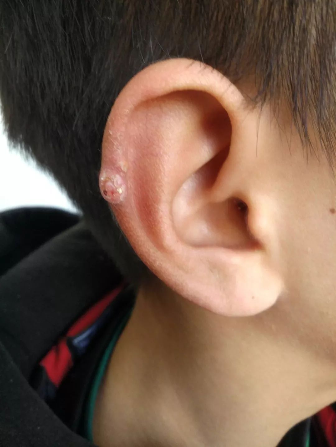 部位黄豆粒大小结节,淡黄色,表面可见白色,黄色颗粒状丘疹,无自觉症状