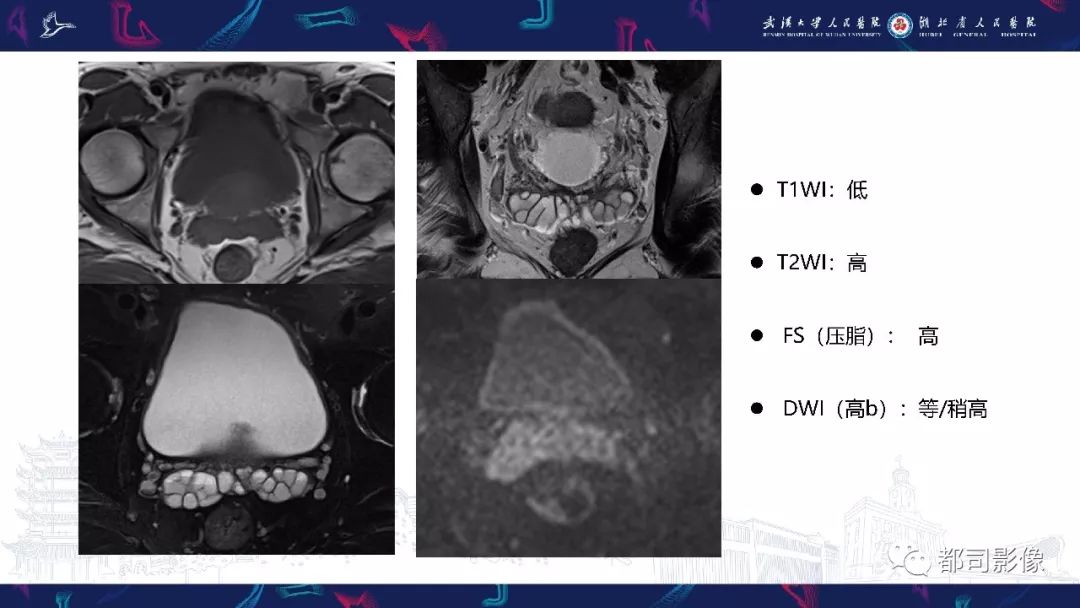 精囊腺病變mri表現