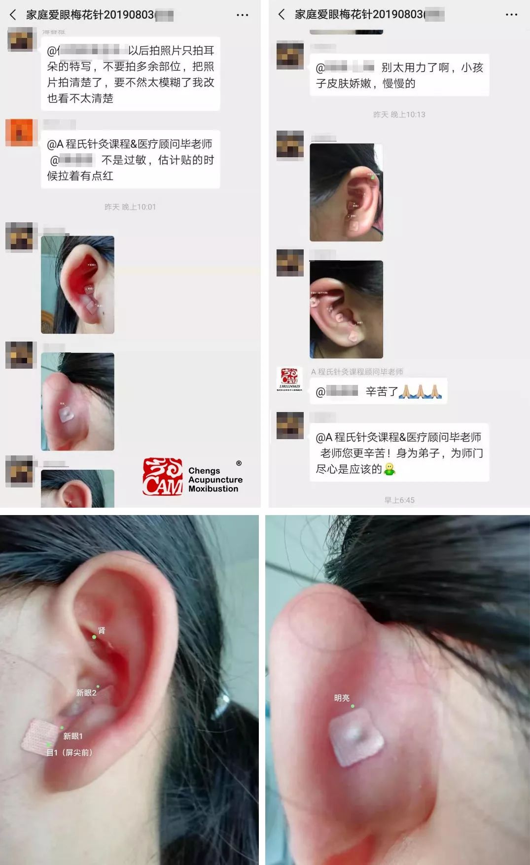 课程主题在家里如何应用梅花针防治近视弱视,缓解眼疲劳技术适用人群