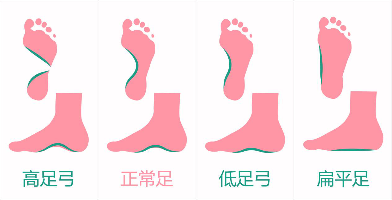 如果足弓不健康,导致足型不正常,会影响足部的支撑与平衡功能,使足部