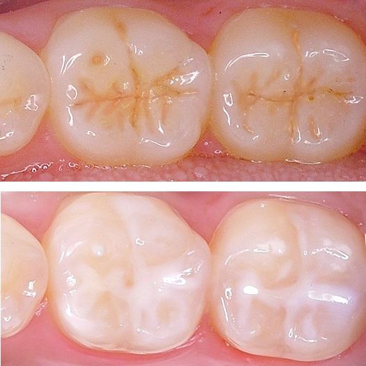 (内含优惠)_牙齿